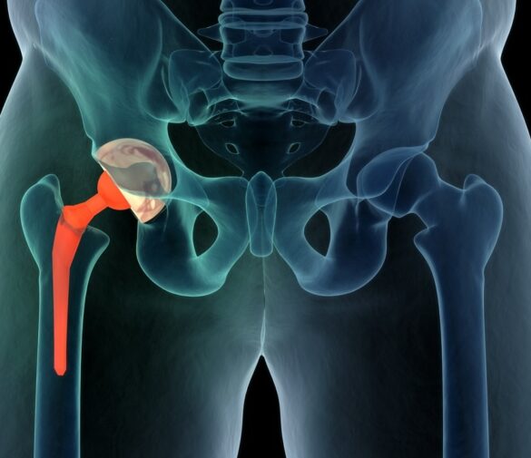 hip replacement surgery in india, hip replacement surgery in pune, hip replacement surgery in mumbai, hip replacement surgery in jaipur